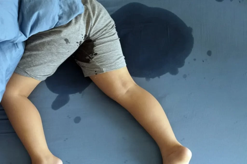 As pernas e a parte inferior do corpo de uma criança de shorts cinza, deitadas em uma cama com uma grande mancha escura de urina no lençol azul. A imagem ilustra o problema da enurese noturna.